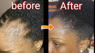 2 Ingredients to grow edges and grow long thicken hair fast Naturally home  Julia Natural Recipes [upl. by Rehpotsrhc]