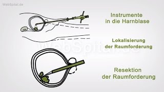 TUR – B oder transurethrale Resektion des Blasetumors [upl. by Drehcir611]