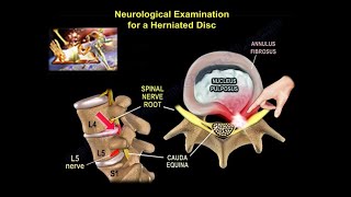 Neurological Examination For A Herniated Disc  Everything You Need To Know  Dr Nabil Ebraheim [upl. by Ronn503]