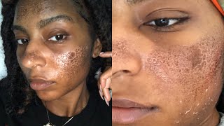 How I Ruined my skin Burned  Scarring amp Hyperpigmentation  Fraxel iamLindaElaine [upl. by Oilisab]