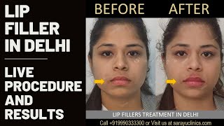 Lip Filler watch full Procedure video at Sarayu Clinics in Delhi by Dr Adarsh Tripathi shorts [upl. by Hacceber50]