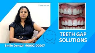 Teeth Gap Solutions smiledentalindia [upl. by Sayette]