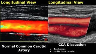 Carotid Artery ColorSpectral Doppler Ultrasound Normal Vs Abnormal Images  ICA Stenosis USG [upl. by Shel]