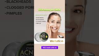 Wellution Cystic Acne Treatment face Cream howtolightendarkspots antiaging [upl. by Berky715]