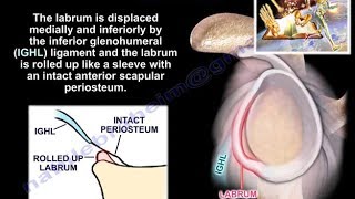 Lesions Of The Shoulder ALPSA lesion  Everything You Need To Know  Dr Nabil Ebraheim [upl. by Mufi]