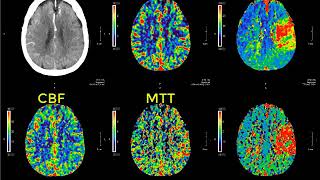 Introduction to CT perfusion before Call [upl. by Esadnac873]