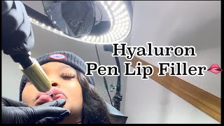 Hyaluron Pen Lip Fillers  Before amp After Needleless 1ml [upl. by Conny]