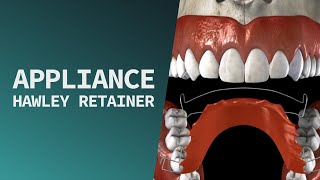 Appliance  Hawley Retainer Procedure [upl. by Eentruok]