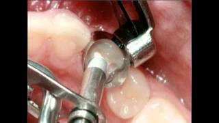 Amalgam Fillings Procedure  Lake Merritt Dental Oakland CA [upl. by Unni]