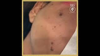 Mole Removal Treatment  Dr Fazeela Abbasi [upl. by Ynney162]