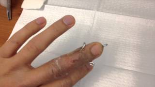 Broken finger pin removal [upl. by Naleek]