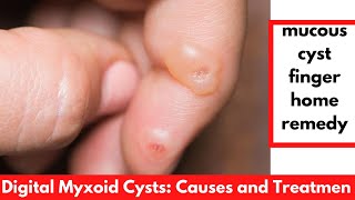 Mucous cyst finger home remedy  Digital Myxoid Cysts Causes and Treatment [upl. by Ewall]