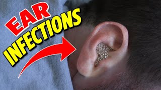 Ear infections the 2 main types [upl. by Acina]