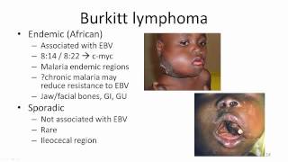 3 Chronic EBV [upl. by Ingrid]