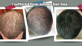 GROW YOUR HAIR BACK 100 HAIR LOSS TREATMENT FOR MEN [upl. by Chelsie]