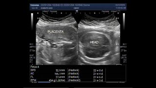 Ultrasound Video showing Oligohydromnios loss of fetal movements with Pregnancy of about 22 weeks [upl. by Meihar]