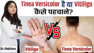 Difference Between Vitiligo and Tinea Versicolor in HIndi  How to Identify This [upl. by Auhesoj71]