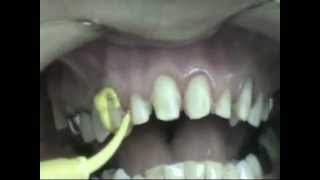 Impression for dental veneers [upl. by Winterbottom]