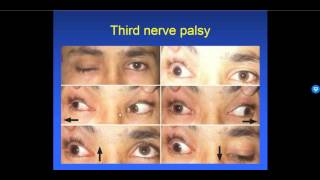 Diplopia 26  Types of Strabismus [upl. by Noit]