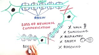 WHAT IS MLD Metachromatic Leukodystrophy explained to all [upl. by Acina]