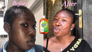 How to use DETTOL Antiseptic Liquid to clear acne  How to get ride of pimples with Dettol [upl. by Amaleta145]