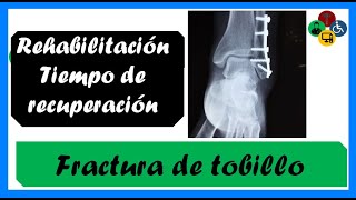 Fractura de TOBILLO  Fractura de TIBIA Y PERONÉ Tiempo de recuperación [upl. by Saunder]