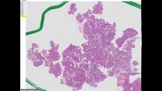 High grade papillary urothelial carcinoma Grade 3 TCC [upl. by Rucker278]