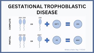 Gestational Trophoblastic Disease Molar Pregnancy Explained [upl. by Seuguh801]