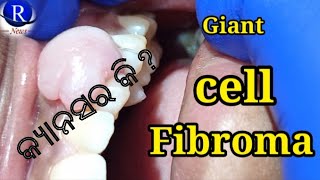 Giant cell Fibroma Is it cancerous [upl. by Urbanna]