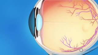 What is glaucoma [upl. by Mcmurry]