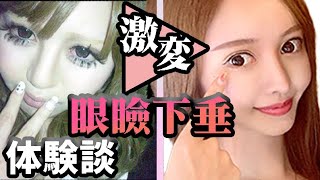 眼瞼下垂の体験談。Before・After・病院名あり【美容整形・整形】 [upl. by Nosnibor948]