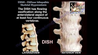 DISH Diffuse Idiopathic Skeletal Hyperostosis  Everything You Need To Know  Dr Nabil Ebraheim [upl. by Hanoy]