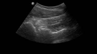 Shoulder Ultrasound Glenohumeral Shoulder Arthrocentesis [upl. by Oicnerolf]