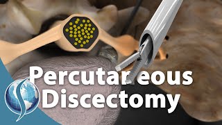 Is Percutaneous Discectomy Better Than Traditional Discectomy [upl. by Abihsat3]