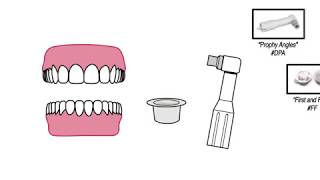 Bonding to Ceramic Crowns Porcelain Lithium Disilicate Zirconia [upl. by Balthasar]