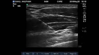 Ultrasound guided Costoclavicular Brachial Plexus Block [upl. by Carmon]