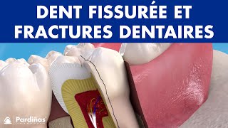 DENTS CASSÉES  Symptômes et types dents fissurées et fractures dentaires © [upl. by Tadeo]