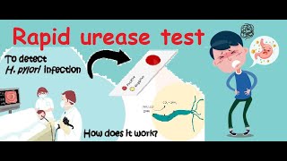 Rapid Urease test for detecting Helicobacter pylori H pylori infection [upl. by Gaves]