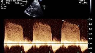 Echocardiogram With Mild Aortic Insufficiency [upl. by Kurr580]