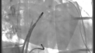 HandsOn Ablation  Video 1218 [upl. by Cristionna]