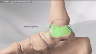 Deltoid Ligament Reconstruction [upl. by Zsazsa583]