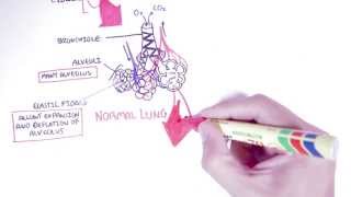 Emphysema  Introduction Types Symptoms Diagnosis [upl. by Boesch700]