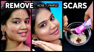 Acne Scars Home Remedies in Tamil  Pimple Marks Removal at Home [upl. by Nylaroc]