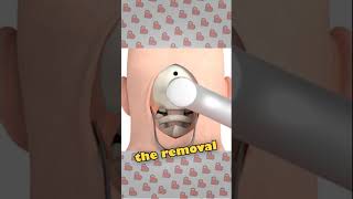 What is a CRANIOTOMY medical skull shorts viralshorts cute shortsfeed eyes asmr [upl. by Inacana882]