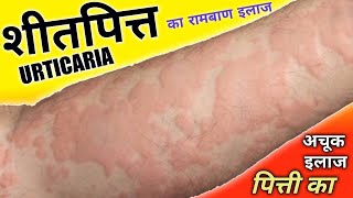 शीतपित्त पित्ती का अचूक इलाज   Urticaria Treatment  Dr Madhusudan [upl. by Zipah]