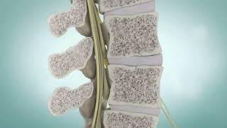 Spinal Stenosis and Spine Surgery  Medical Animation [upl. by Asoramla]