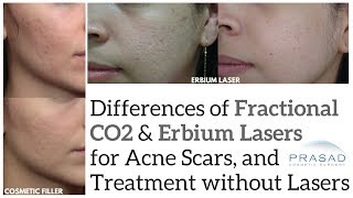 Acne scar subcision and filler [upl. by Hsinam822]