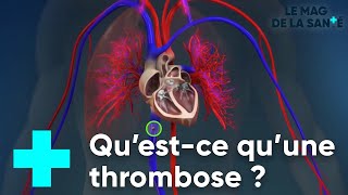 La thrombose veineuse  Le Magazine de la Santé [upl. by Abramo]