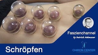 Warum Schröpfen Hacamat Hijama helfen kann bei Rückenschmerzen oder Verspannung Eine Anleitung [upl. by Rabkin]