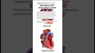 Managing left ventricular outflow tract LVOT obstruction in hypertrophic cardiomyopathy HCM [upl. by Ellerrehc]